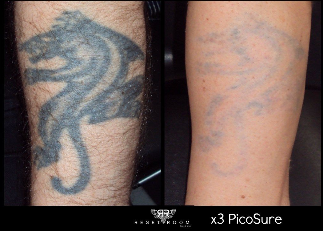 28 Wrecking Balm Tattoo Removal Before And After Ideas