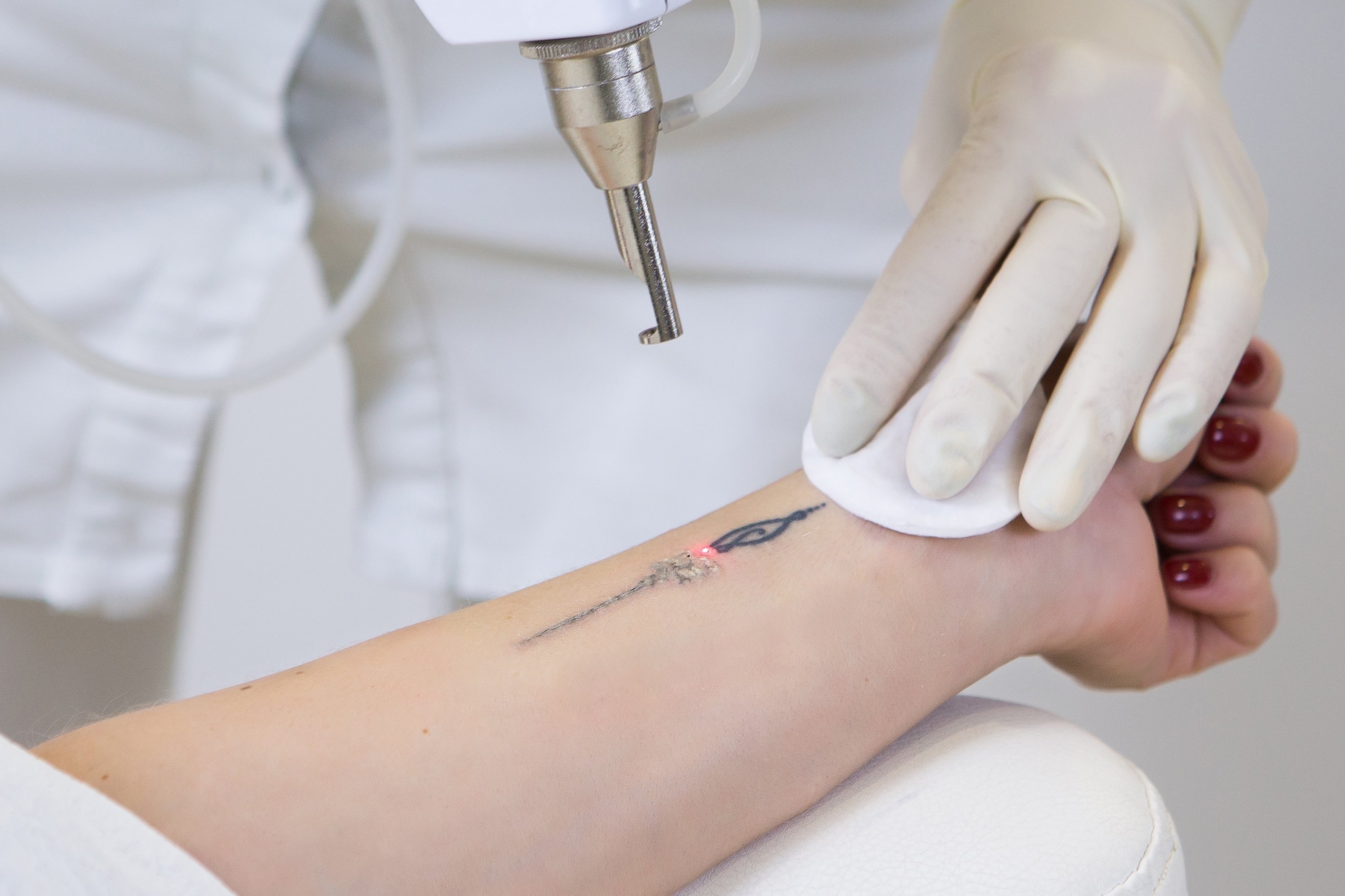 How To Remove Tattoos Without Laser Treatment Pros Cons