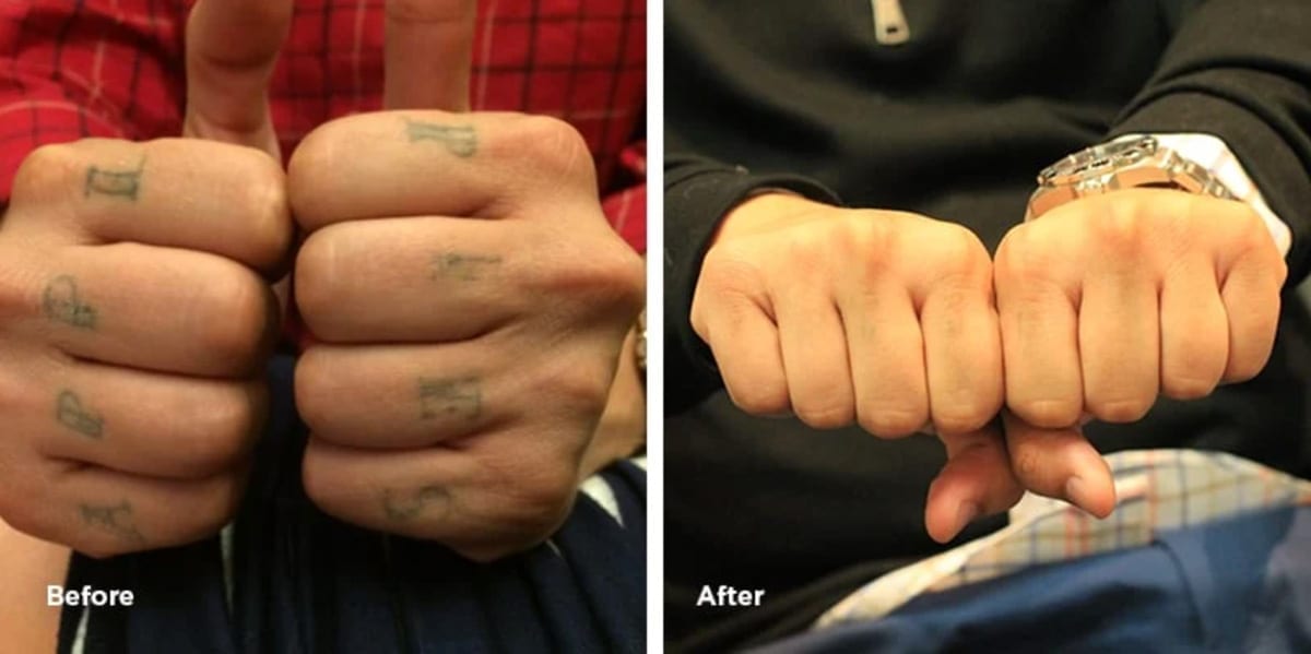 Knuckle Tattoo Removal Zulma Singeltary