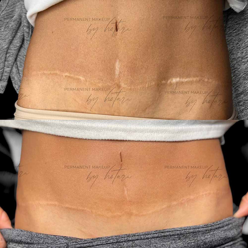 Tummy Tuck Scar Tattoo Cover Up Cosmetic Surgery Tips