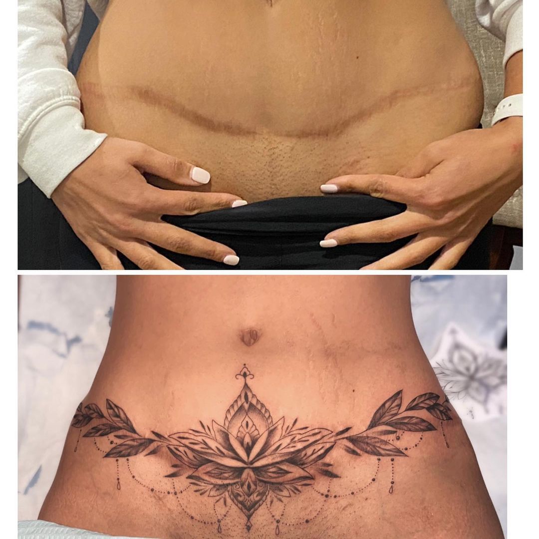 Tummy Tuck Tattoos Tattoos Over Tummy Tuck Scars 02 Tattoos