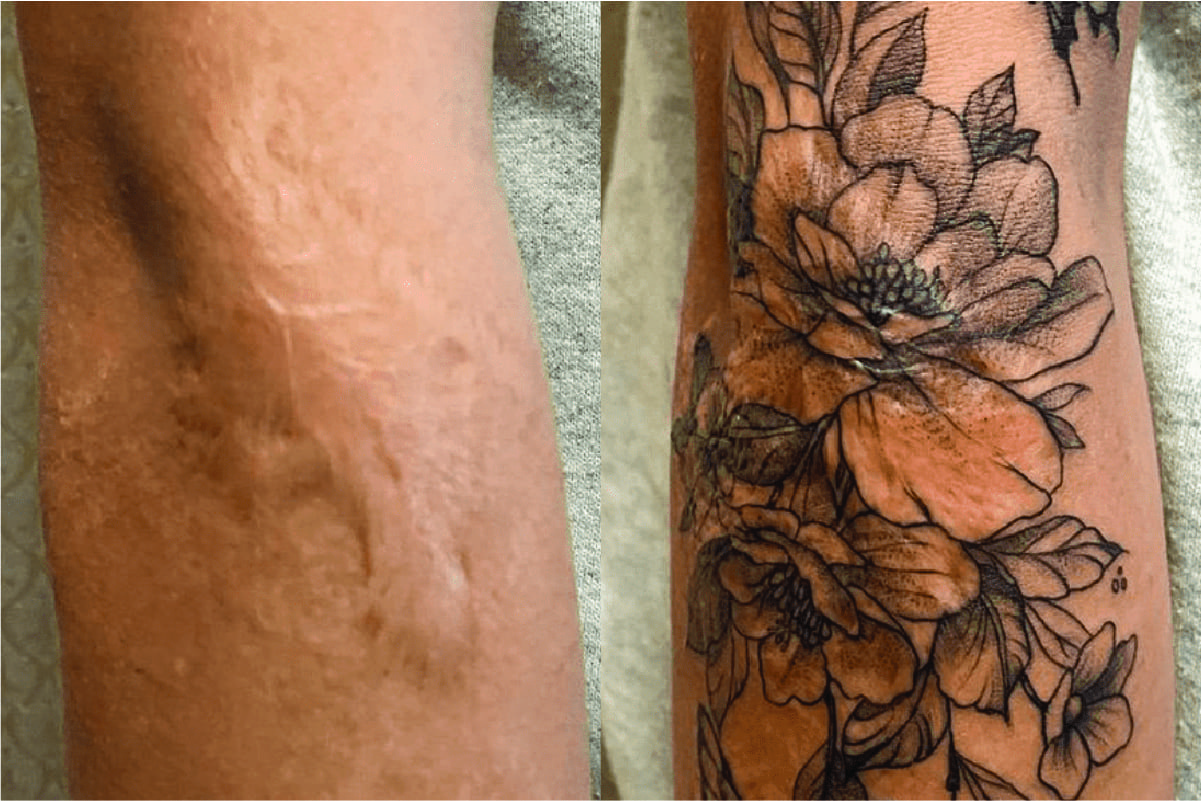 Update 76 Forearm Scar Cover Up Tattoo In Eteachers